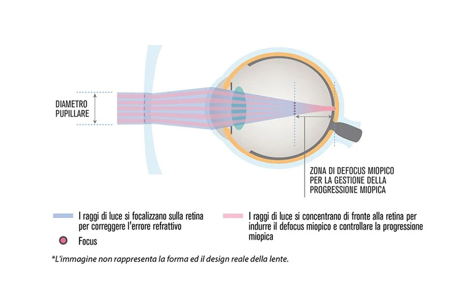 La tecnologia D.I.M.S. delle lenti MiyoSmart di Hoya - Ottica Calcagni - Oggiono, Lecco