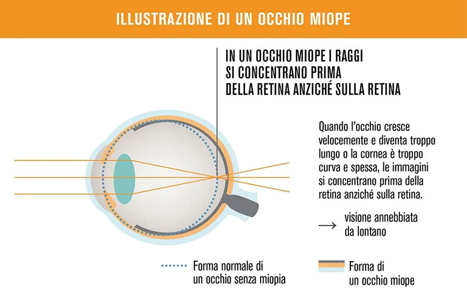 Correggi e rallenta la miopia con Ottica Calcagni di Oggiono in provincia di Lecco